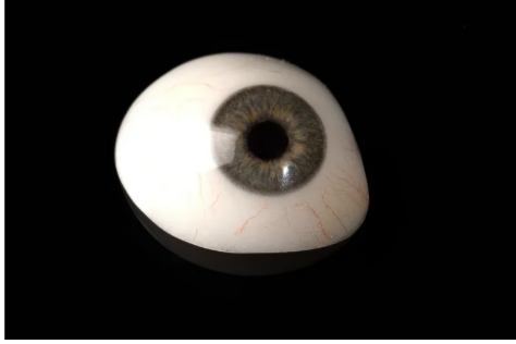 Custom ocular prosthesis (artificial eye) crafted at Comfy Denture & Hearing Clinic